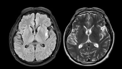 MRI brain scan axial T1W for detect Brain diseases such as stroke disease, Brain tumors and Infections.
