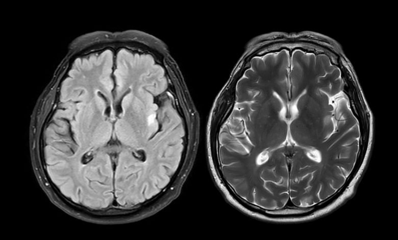 MRI brain scan axial T1W for detect Brain diseases such as stroke disease, Brain tumors and Infections.